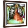 Heart Pacemaker, X-ray-Du Cane Medical-Framed Photographic Print