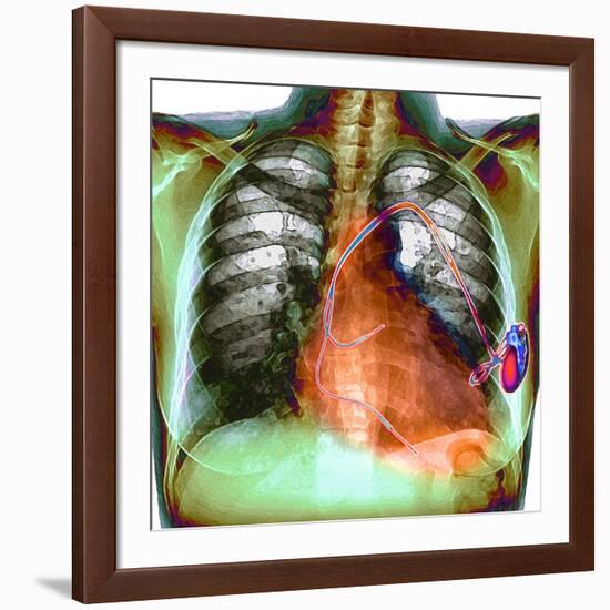 Heart Pacemaker, X-ray-Du Cane Medical-Framed Photographic Print