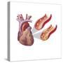 Heart with Arteries Showing Cholesterol in One and Plaque in the Other-null-Stretched Canvas