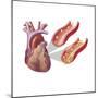 Heart with Arteries Showing Cholesterol in One and Plaque in the Other-null-Mounted Premium Giclee Print