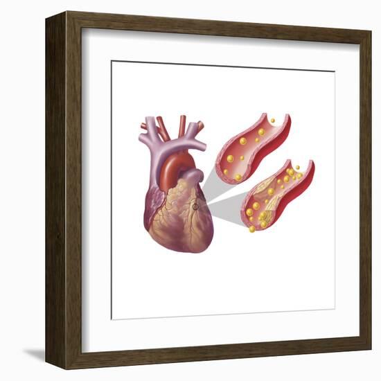 Heart with Arteries Showing Cholesterol in One and Plaque in the Other-null-Framed Art Print