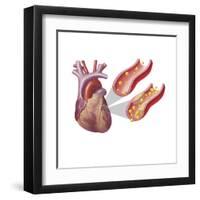 Heart with Arteries Showing Cholesterol in One and Plaque in the Other-null-Framed Art Print