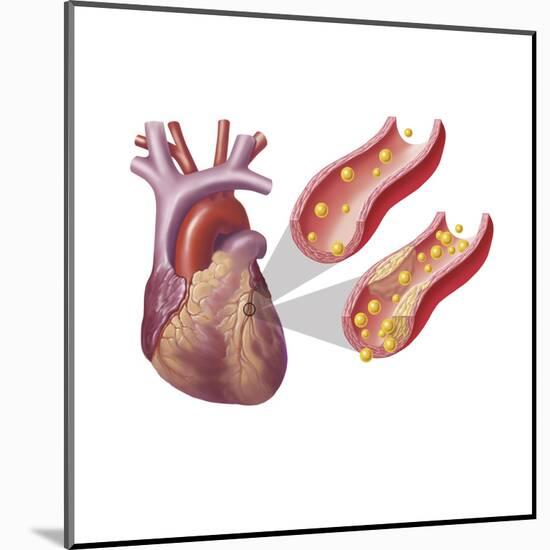 Heart with Arteries Showing Cholesterol in One and Plaque in the Other-null-Mounted Art Print