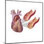 Heart with Arteries Showing Cholesterol in One and Plaque in the Other-null-Mounted Art Print