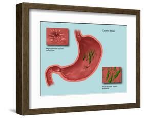 Helicobacter Pylori Infection, Illustration-Gwen Shockey-Framed Giclee Print