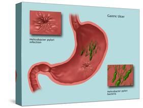 Helicobacter Pylori Infection, Illustration-Gwen Shockey-Stretched Canvas