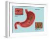 Helicobacter Pylori Infection, Illustration-Gwen Shockey-Framed Giclee Print