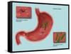 Helicobacter Pylori Infection, Illustration-Gwen Shockey-Framed Stretched Canvas