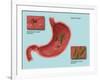 Helicobacter Pylori Infection, Illustration-Gwen Shockey-Framed Giclee Print