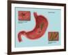 Helicobacter Pylori Infection, Illustration-Gwen Shockey-Framed Giclee Print
