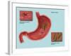 Helicobacter Pylori Infection, Illustration-Gwen Shockey-Framed Giclee Print