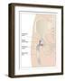 Hip Replacement, Artwork-Peter Gardiner-Framed Photographic Print