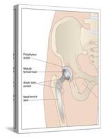 Hip Replacement, Artwork-Peter Gardiner-Stretched Canvas