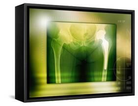 Hip Replacement, X-ray-Miriam Maslo-Framed Stretched Canvas