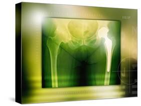 Hip Replacement, X-ray-Miriam Maslo-Stretched Canvas