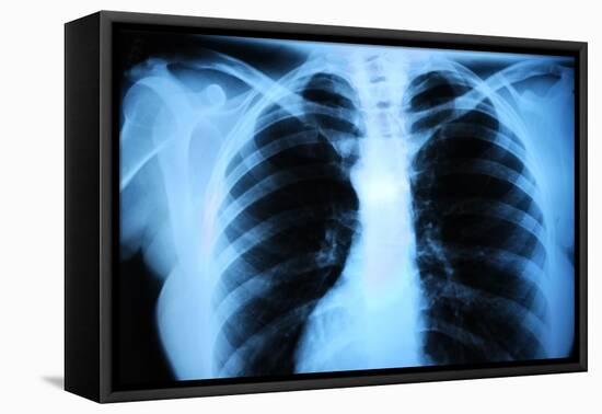 Human Body's Radiograph-Sergieiev-Framed Stretched Canvas