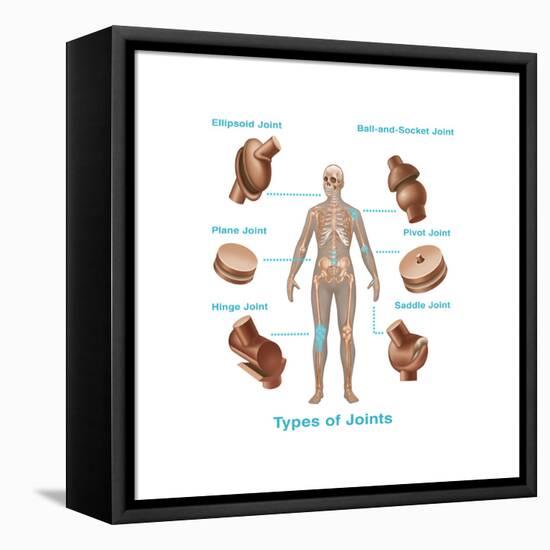 Human Joint Replacements, Illustration-Gwen Shockey-Framed Stretched Canvas