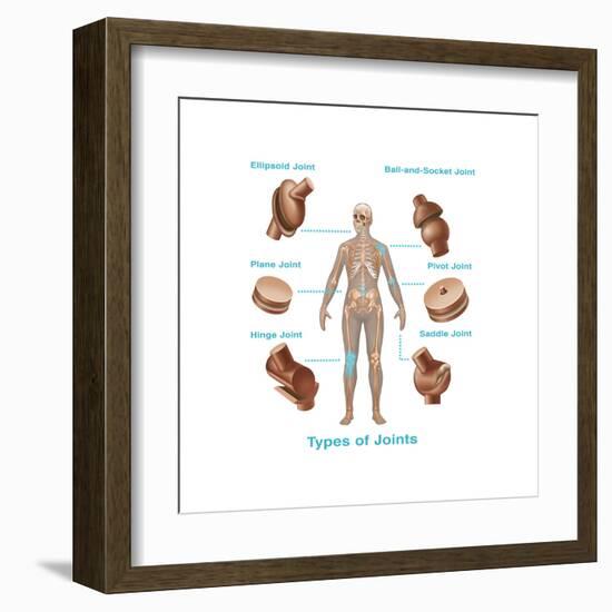 Human Joint Replacements, Illustration-Gwen Shockey-Framed Art Print