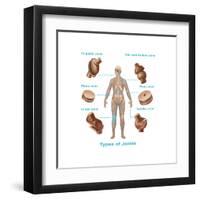 Human Joint Replacements, Illustration-Gwen Shockey-Framed Art Print