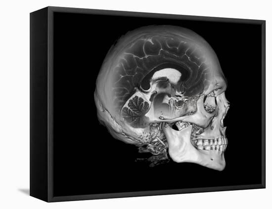 Human Skull and Brain, CT and MRI Scans-null-Framed Stretched Canvas