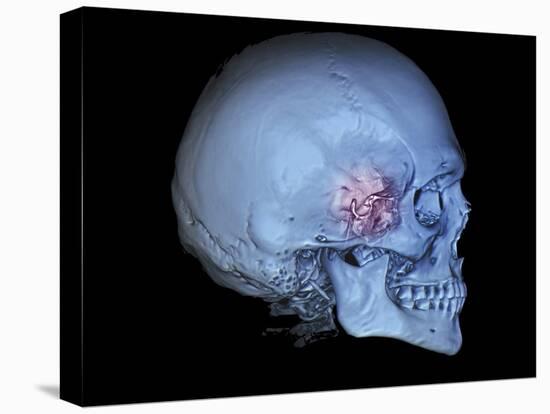 Human Skull and Site of Pituitary Gland, 3D CT Scan-null-Stretched Canvas