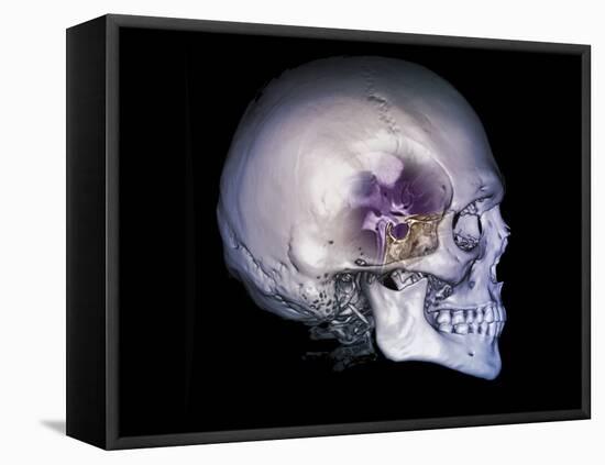 Human Skull and Site of Pituitary Gland, CT and MRI Scans-null-Framed Stretched Canvas