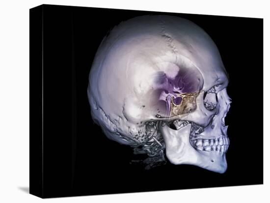 Human Skull and Site of Pituitary Gland, CT and MRI Scans-null-Stretched Canvas