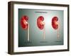 Hydronephrosis Condition of the Kidney-null-Framed Art Print