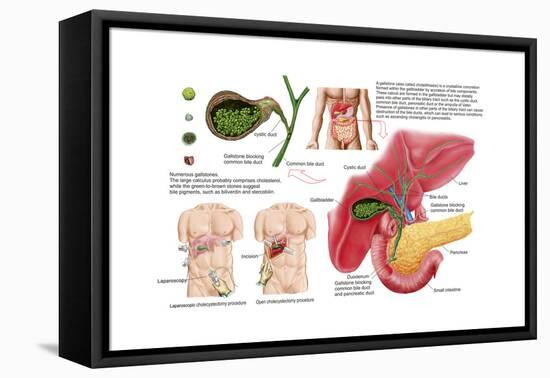 Illustration Depicting Cholecystectomy, the Surgical Removal of the Gallbladder-null-Framed Stretched Canvas