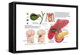 Illustration Depicting Cholecystectomy, the Surgical Removal of the Gallbladder-null-Framed Stretched Canvas