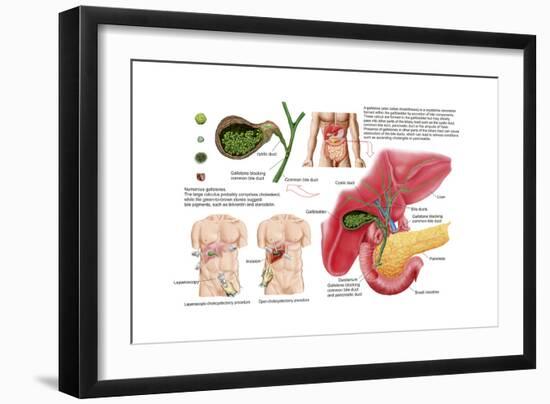 Illustration Depicting Cholecystectomy, the Surgical Removal of the Gallbladder-null-Framed Art Print