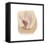 Illustration of a Cystocele Between a Woman's Bladder and Vaginal Wall-null-Framed Stretched Canvas