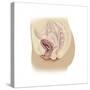 Illustration of a Cystocele Between a Woman's Bladder and Vaginal Wall-null-Stretched Canvas