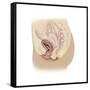 Illustration of a Cystocele Between a Woman's Bladder and Vaginal Wall-null-Framed Stretched Canvas