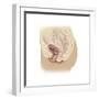 Illustration of a Cystocele Between a Woman's Bladder and Vaginal Wall-null-Framed Premium Giclee Print