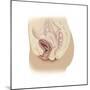 Illustration of a Cystocele Between a Woman's Bladder and Vaginal Wall-null-Mounted Premium Giclee Print