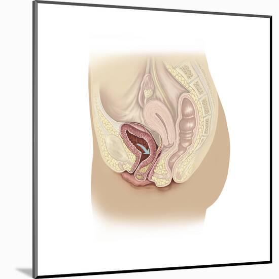 Illustration of a Cystocele Between a Woman's Bladder and Vaginal Wall-null-Mounted Art Print