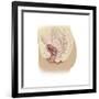 Illustration of a Cystocele Between a Woman's Bladder and Vaginal Wall-null-Framed Art Print