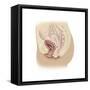 Illustration of a Cystocele Between a Woman's Bladder and Vaginal Wall-null-Framed Stretched Canvas