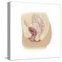 Illustration of a Cystocele Between a Woman's Bladder and Vaginal Wall-null-Stretched Canvas
