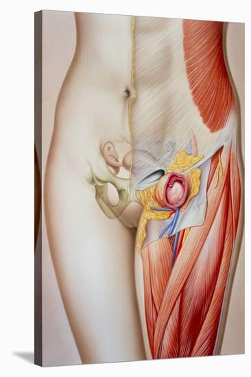 Illustration of a Femoral Hernia-John Bavosi-Stretched Canvas