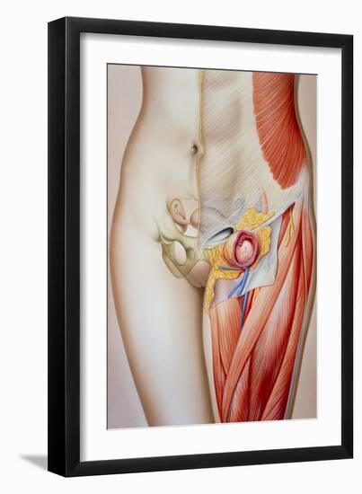 Illustration of a Femoral Hernia-John Bavosi-Framed Photographic Print