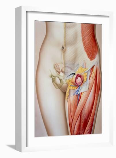 Illustration of a Femoral Hernia-John Bavosi-Framed Photographic Print