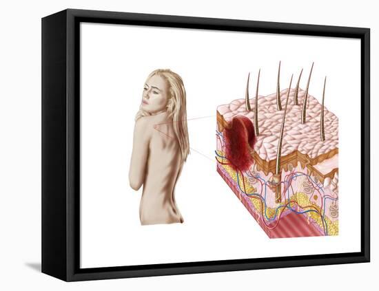 Illustration of an Atypical Growth on the Skin That Could Be a Sign of Skin Cancer-null-Framed Stretched Canvas