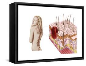 Illustration of an Atypical Growth on the Skin That Could Be a Sign of Skin Cancer-null-Framed Stretched Canvas