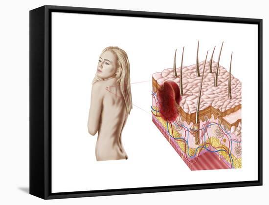 Illustration of an Atypical Growth on the Skin That Could Be a Sign of Skin Cancer-null-Framed Stretched Canvas