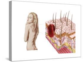 Illustration of an Atypical Growth on the Skin That Could Be a Sign of Skin Cancer-null-Stretched Canvas