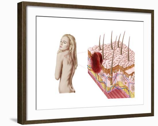 Illustration of an Atypical Growth on the Skin That Could Be a Sign of Skin Cancer-null-Framed Art Print