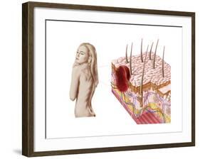 Illustration of an Atypical Growth on the Skin That Could Be a Sign of Skin Cancer-null-Framed Art Print