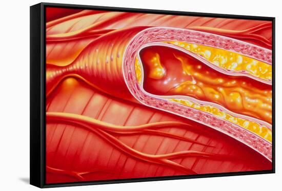 Illustration of Coronary Artery Atherosclerosis-John Bavosi-Framed Stretched Canvas